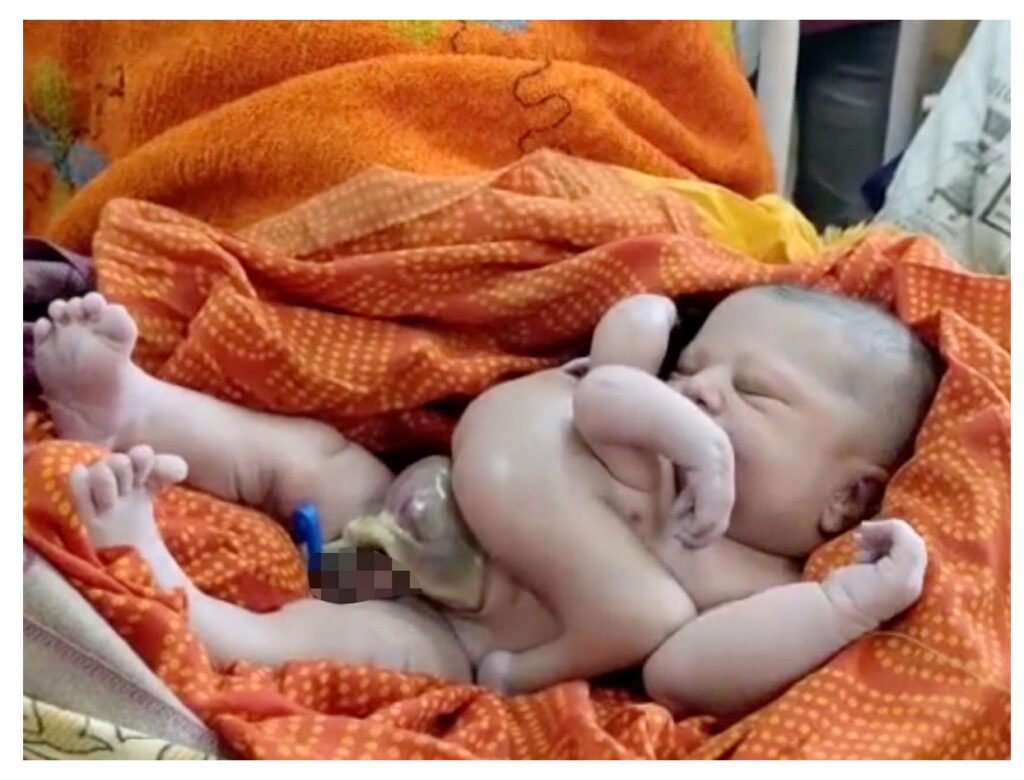 Wonder Of Nature : महिला ने दिया चार हाथ-चार पैर वाले बच्चे को जन्म