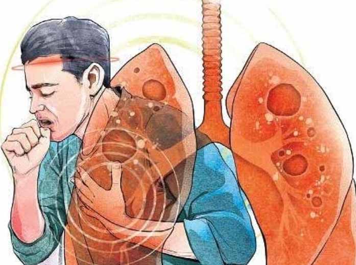 Tuberculosis : कोरोना के बाद बढ़े 30 फीसदी टीबी के मरीज