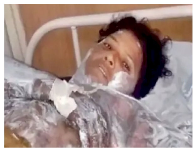 MP Guna : जिंदा जलाई गई आदिवासी महिला हारी जिंदगी की जंग, अस्पताल में तोड़ा दम