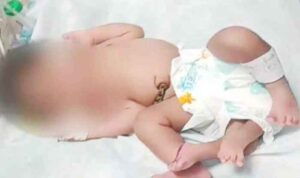 Gwalior News : महिला ने दिया 4 पैर वाली बच्ची को जन्म, अस्पताल में उमड़े लोग, डॉक्टरों ने कही ये बात