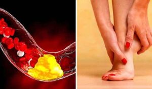 Read more about the article High Cholesterol : पैरों में दर्द भी हो सकता है हाई कोलेस्ट्रॉल का लक्षण, नजरअंदाज करना पड़ सकता है भारी