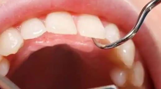 Gnashing of teeth