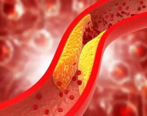 Read more about the article Cholesterol : इन 6 आदतों के कारण आपका कोलेस्ट्रॉल लेवल रहता है हाई