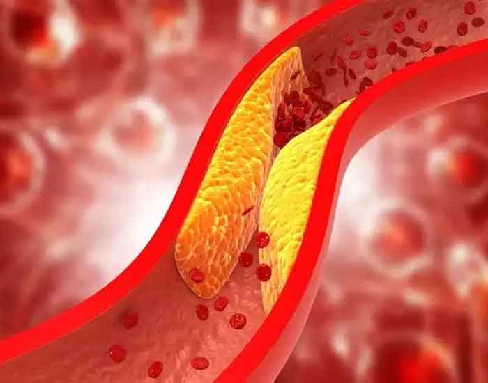 Cholesterol : इन 6 आदतों के कारण आपका कोलेस्ट्रॉल लेवल रहता है हाई