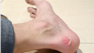 Read more about the article Shoe bite : शू बाइट के नाम से जाना जाता है जूते पहनने के कारण पैरों में हो गए छाले, 5 घरेलू नुस्खों से पाए राहत