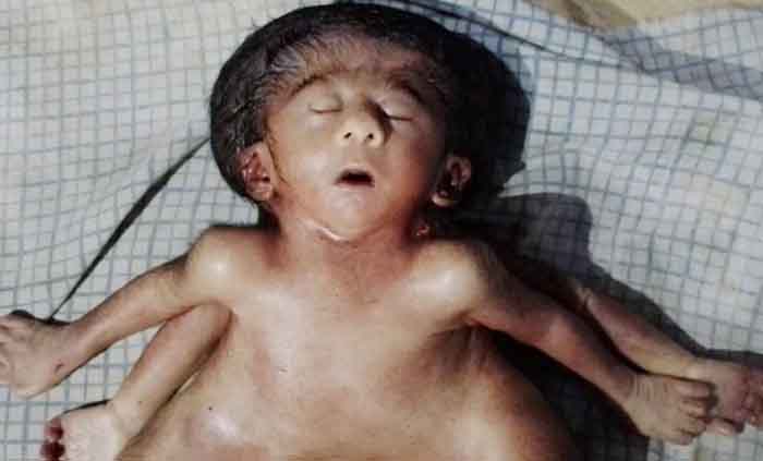 Patna Bihar News : 4 हाथ, 4 पैर, 2 दिल वाली विचित्र बच्ची का हुआ जन्म, देखकर हैरान हो रहे लोग