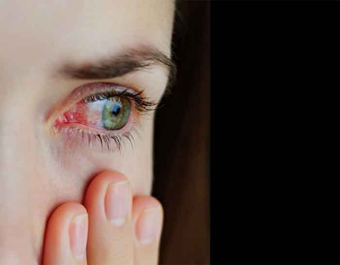 Eye Flu की दुर्ग में दस्तक, आखों में लालिमा और दर्द से परेशान हो रहे मरीज