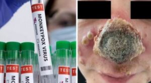 Most dangerous case of monkeypox : यहां मिला मंकीपॉक्स का सबसे खतरनाक मामला, काले घाव की तरह सड़ रही मरीज की नाक